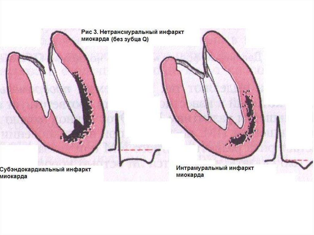 Признаки трансмурального инфаркта. Передний инфаркт миокарда без зубца q. Нетрансмуральный инфаркт ЭКГ. Инфаркт миокарда субэндокардиальный интрамуральный. Инфаркт миокарда с зубцом q и без зубца q.