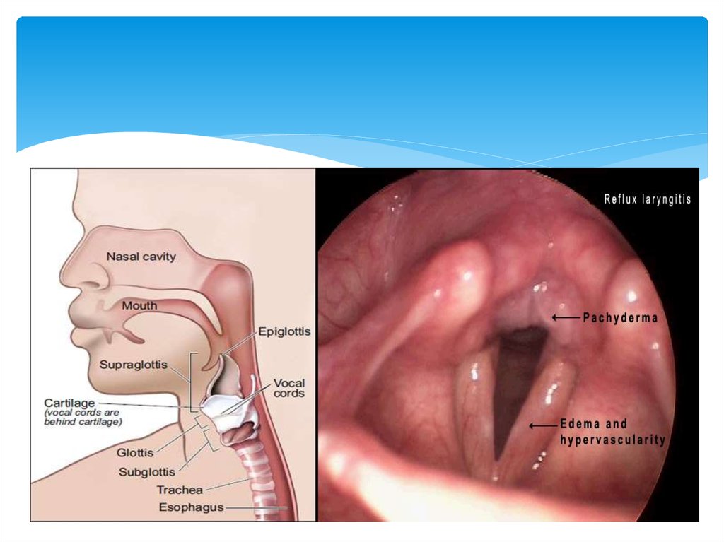 Laryngeal Edema And Stenosis 