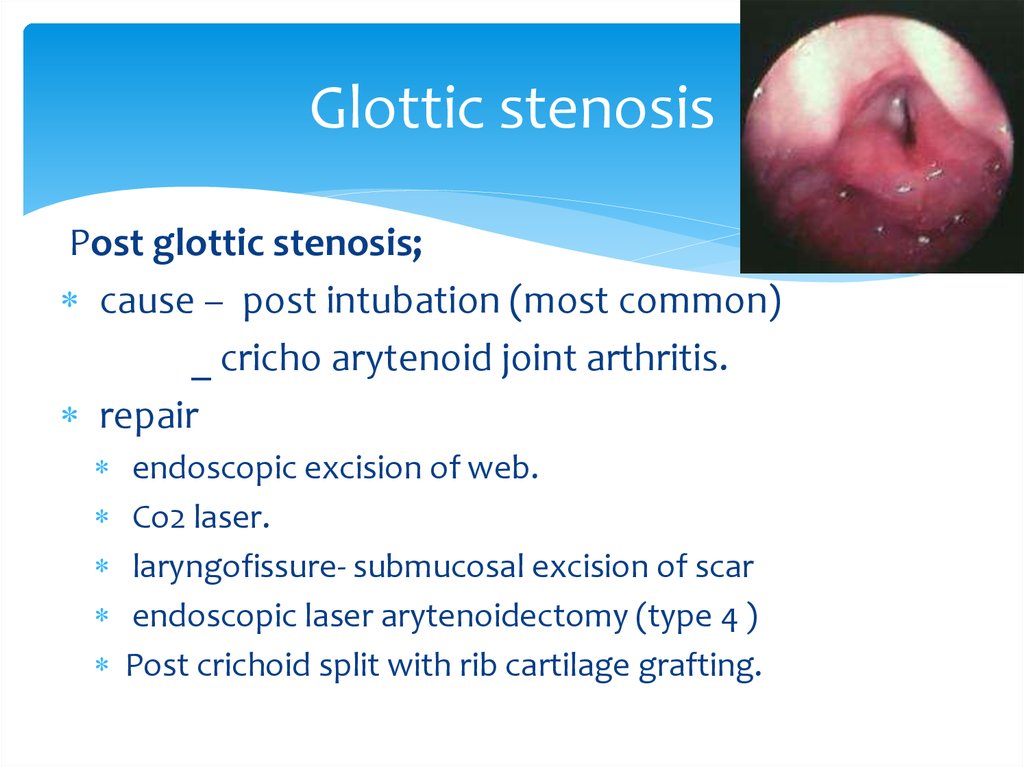 Glottic stenosis