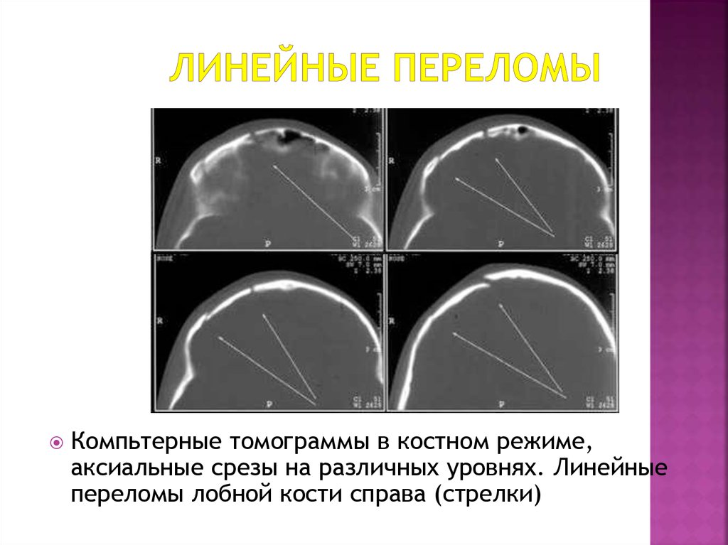 Импрессионный перелом. Линейные переломы плоских костей. Одинарный линейный перелом.