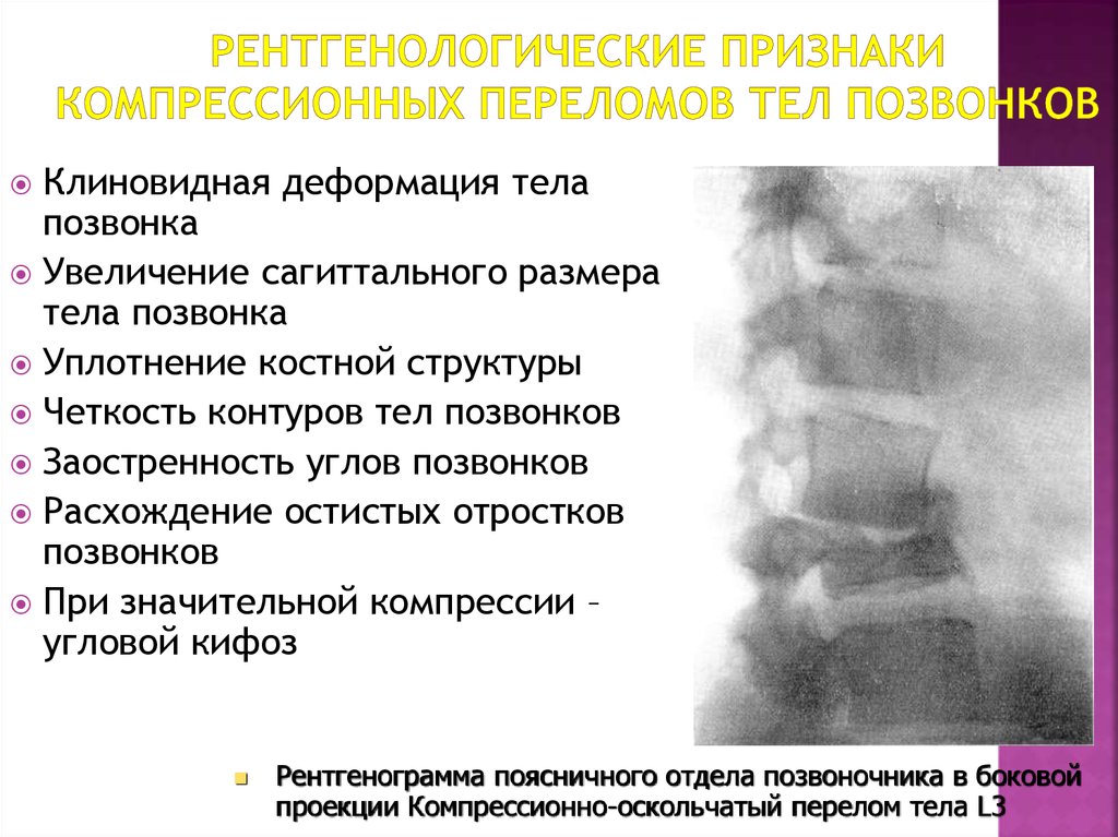 Рентгенологические признаки компрессионных переломов тел позвонков