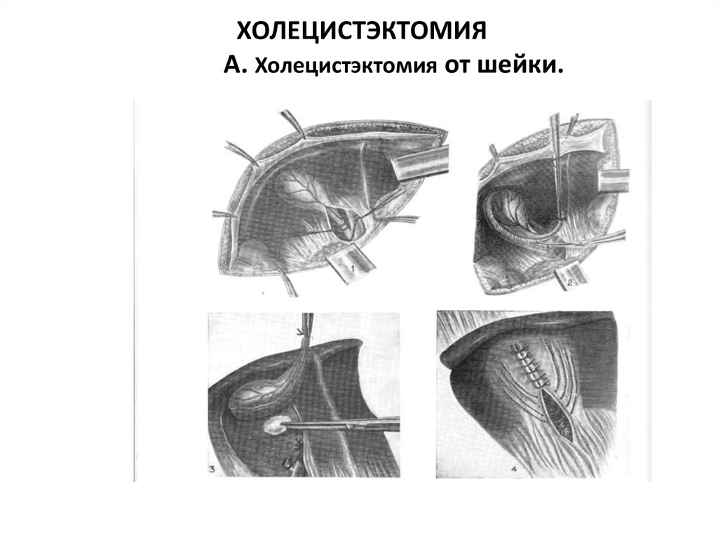 Под этн. Холецистэктомия ход операции. Этапы операции холецистэктомии. Этапы холецистэктомии от шейки. Холецистэктомия Оперативная хирургия.