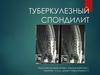 Туберкулезный спондилит