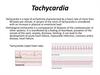 Tachycardia