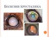 Болезни хрусталика