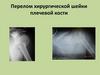 Перелом хирургической шейки плечевой кости