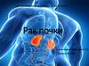 Рак почки