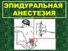 Эпидуральная анестезия