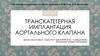 Транскатетерная имплантация аортального клапана