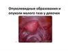 Опухолевидные образования и опухоли малого таза у девочек