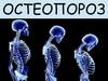 Остеопороз. Факторы риска. Патогенез. Клинические проявления. Лечение. Профилактика