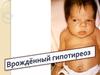 Врожденный гиподиреоз