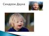 Синдром Дауна