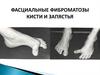Фасциальные фиброматозы кисти и запястья