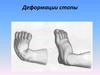 Деформации стопы