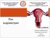 Рак эндометрия