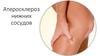Атеросклероз нижних сосудов