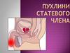 Урологія. Пухлини статевого члена