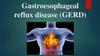 Gastroesophageal reflux disease (GERD)