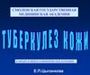 Туберкулез кожи