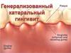 Генерализированный катаральный гингивит