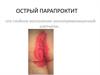 Острый парапроктит