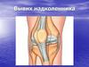 Вывих надколенника