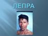 Лепра. Классификация групп лепры. Лечение