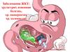 Заболевания ЖКТ: хронический гастрит, язвенная болезнь, хронический панкреатит, хронический холецистит