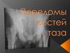 Переломы костей таза