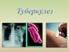 Туберкулез. Туберкулез бактериялары