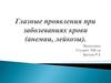 Глазные проявления при заболеваниях крови (анемии, лейкозы)
