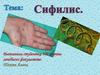 Сифилис