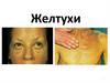 Желтуха (истинная). Желтуха ложная (псевдожелтуха)
