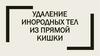 Удаление инородных тел из прямой кишки