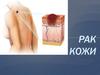 Рак кожи