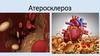 Атеросклероз. Клинические проявления атеросклероза
