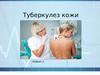 Туберкулез кожи