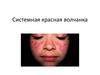 Системная красная волчанка