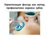 Герметизация фиссур как метод профилактики кариеса зубов