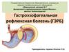 Гастроэзофагеальная рефлюксная болезнь