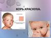 Корь. Краснуха