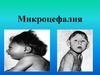 Микроцефалия