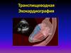 Транспищеводная Эхокардиография