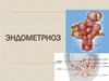 Эндометриоз