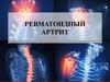 Ревматоидный артрит