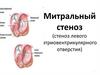Митральный стеноз (стеноз левого атриовентрикулярного отверстия)