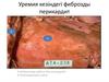 Уремия кезіндегі фиброзды перикардит