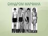 Синдром Марфана