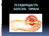 Псевдоподагра. Болезнь Тимана